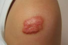 Giảm sự xuất hiện của sẹo bằng 3 cách mà bạn nên biết.