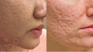 Thế nào là sẹo lõm ?