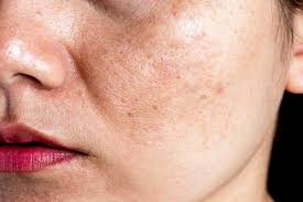 3 Phương Pháp Trị Nám Da Tại Nhà Hiệu Quả Từ Thiên Nhiên