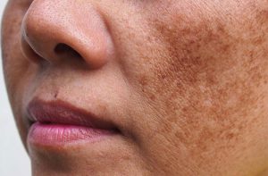 Tìm hiểu về cơ chế hình thành nám để phòng ngừa đúng cách