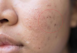 Giải pháp điều trị tăng sắc tố sau mụn