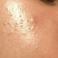 điều trị mụn ẩn