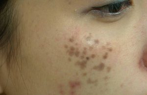 Nám chân sâu là gì