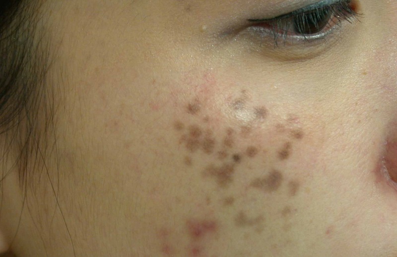 Nám chân sâu là gì