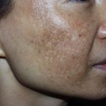 Điều Trị Nám Nội Tiết