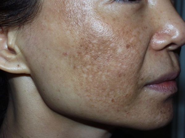 Điều Trị Nám Nội Tiết